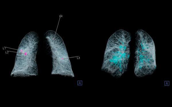 IA evaluacion pulmonar